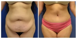 شد البطن الجراحي