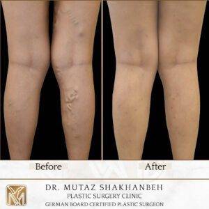 الوذمة الشحمية - الليبيديما