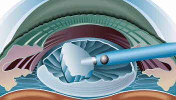 Cataract Surgery 1 1