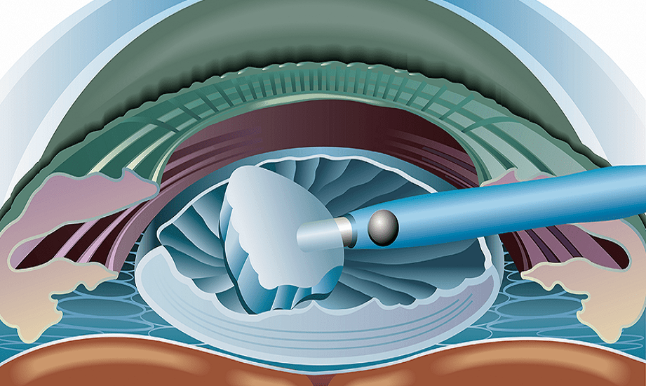 عملية الماء الابيض