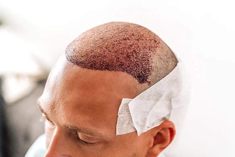 زراعة الشعر