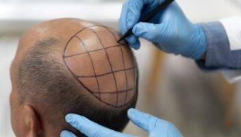 mature man going through follicular unit extraction process scaled