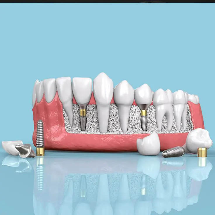 زراعة الأسنان