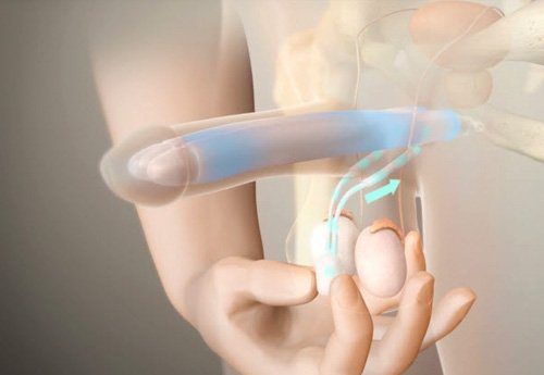 الدعامة الهيدروليكية