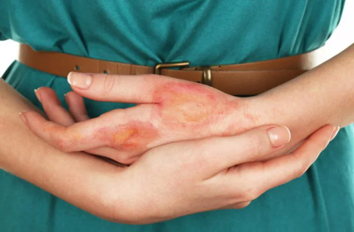 Tratamiento de quemaduras y reparación de la piel en Jordania