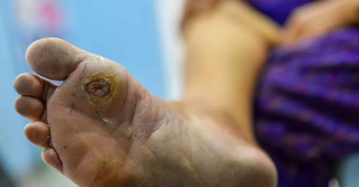 Tratamiento del pie diabético en Jordania