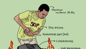 enfermedad inflamatoria intestinal