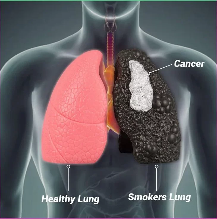 lung cancer treatment in jordan
