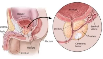 prostate cancer treatment in jordan