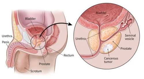 prostate cancer treatment in jordan
