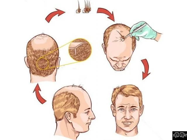 Etapas del crecimiento del cabello después del trasplante capilar en Jordania, mes a mes.