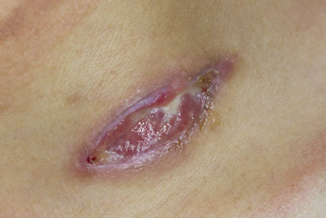 علاج الجروح الملتهبة والمتقيحة في الأردن