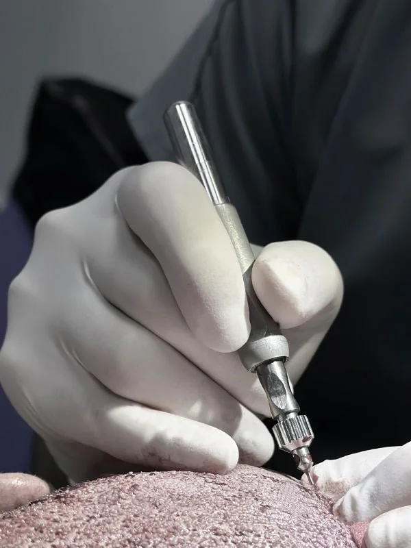 Comparación de las técnicas Zafiro y FUE convencional en el trasplante capilar en Jordania