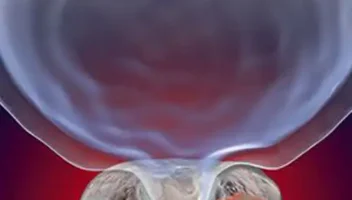 Prostate Cancer